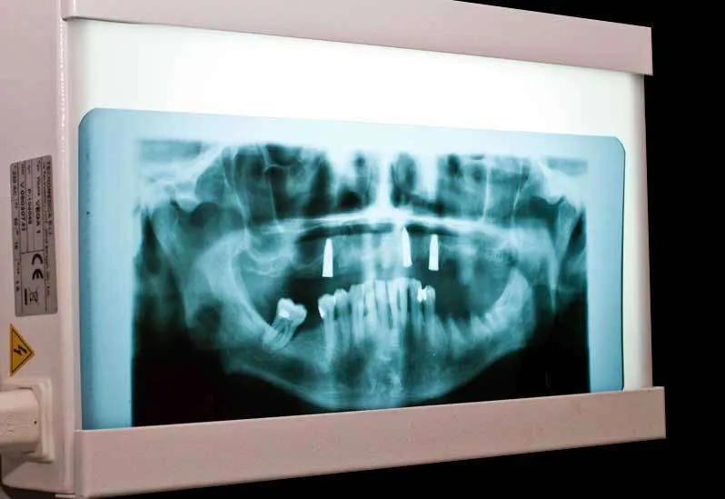 Bruxismo, ¿Aprietas los dientes?
