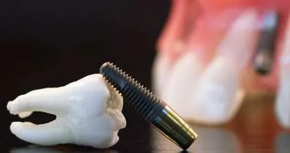 El precio de los implantes dentales