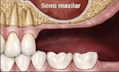 Técnica de Summers para la elevación del seno maxilar Técnica de Summers para la elevación del seno maxilar