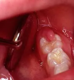 Complicaciones infecciosas o pericoronitis Complicaciones infecciosas o pericoronitis