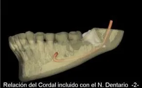 Complicaciones neuromusculares Complicaciones neuromusculares