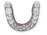 Apiñamiento de los dientes