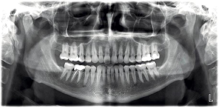Resultado de imagen de ortopantomografia