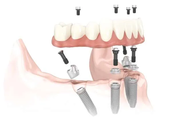 Implantes dentales Barcelona: técnica All-on-4 Implantes dentales Barcelona: técnica All-on-4