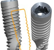 Tipos de implantes dentales Tipos de implantes dentales