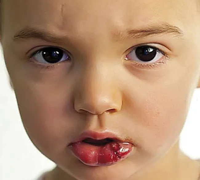 Golpe en dientes de leche Golpe en dientes de leche