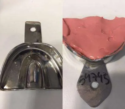 son los moldes dentales o impresiones dentales son los moldes dentales o impresiones dentales