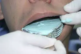 son los moldes dentales o impresiones dentales son los moldes dentales o impresiones dentales