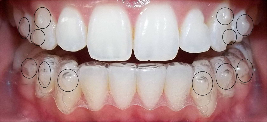 Proceso colocacion Invisalign Proceso colocacion Invisalign