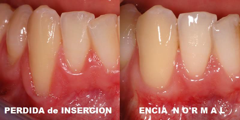 ¿Qué es la regeneración ósea en la periodontitis? ¿Qué es la regeneración ósea en la periodontitis?