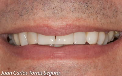 Nuevo caso del Doctor Torres: extracción del resto radicular, regeneración ósea y la colocación de un implante dental