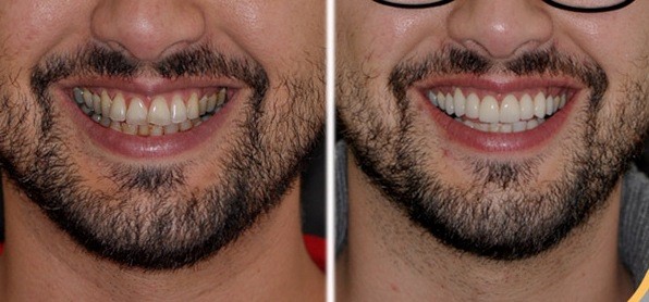 Fundas dentales Fundas dentales
