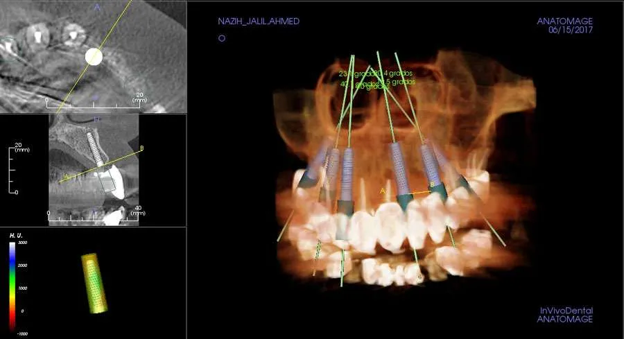 Técnicas de implantes dentales Técnicas de implantes dentales