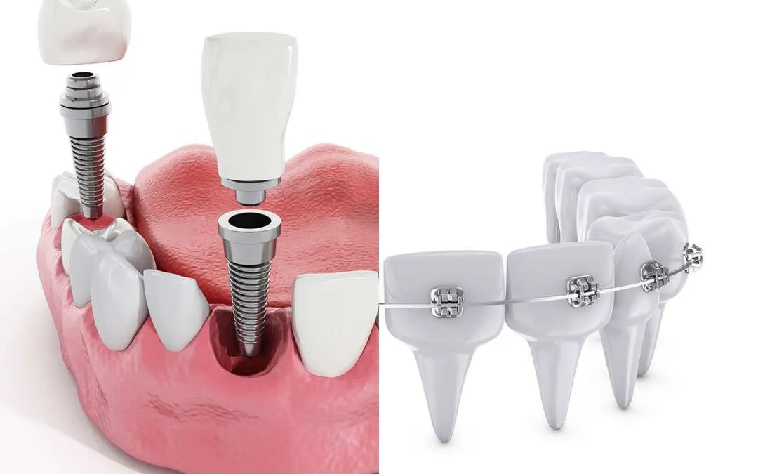 Implantes dentales y ortodoncia