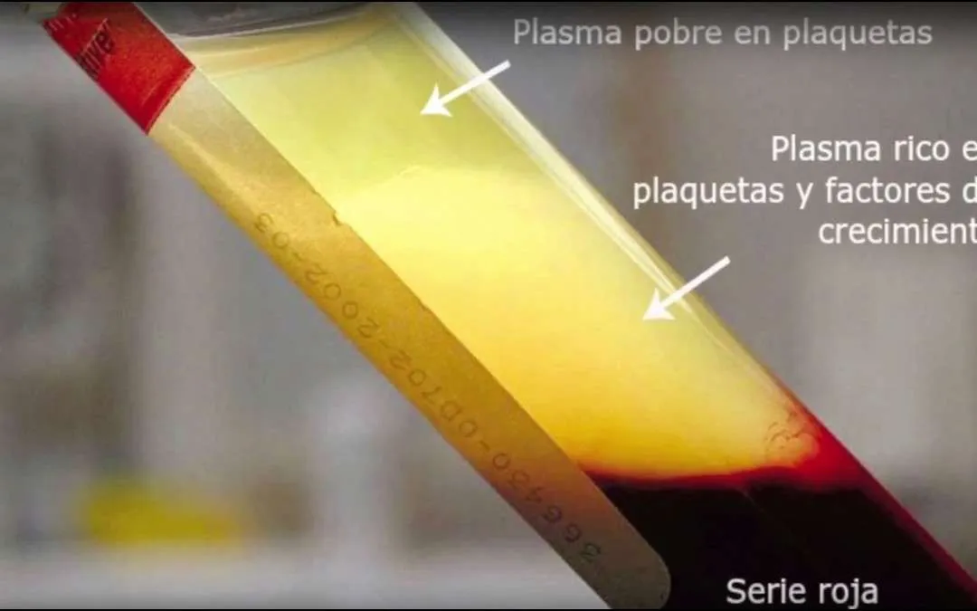 Mejoramos el proceso de recuperación de nuestros tratamientos gracias al Plasma Rico en Fibrina