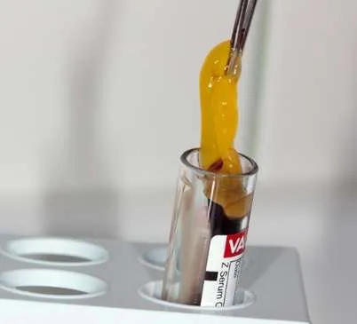 Cómo se prepara el Plasma Rico en Fibrina