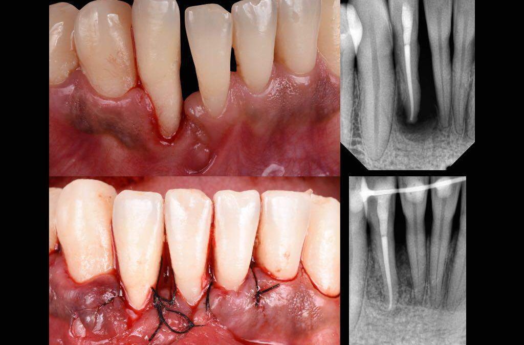 Cirugía Periodontal de última generación