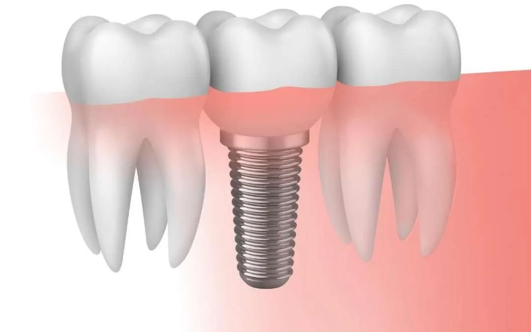De dental precios implantologia
