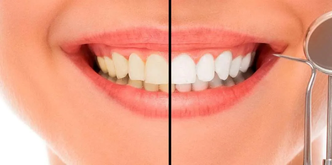 ¿Qué sabes del blanqueamiento dental?