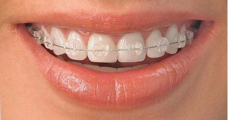 Ventajas brackets metálicos Ventajas brackets metálicos
