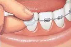 Cómo colocar cera en los brackets Cómo colocar cera en los brackets