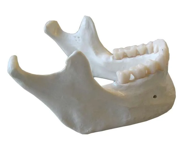 Osteoradionecrosis en maxilar y mandíbula Osteoradionecrosis en maxilar y mandíbula