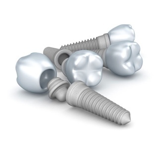 Reparación de implantes dentales Reparación de implantes dentales