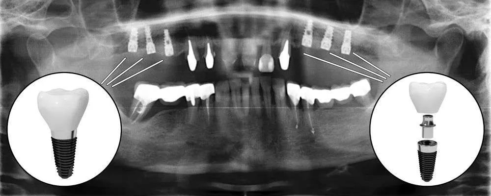 Tipos de implantes dentales