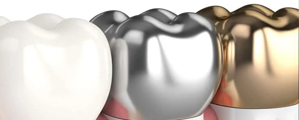 Tipos de coronas dentales