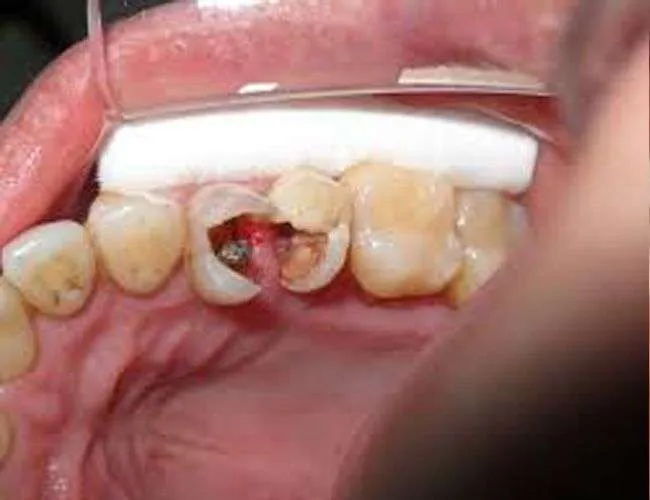 Caries dental Caries dental