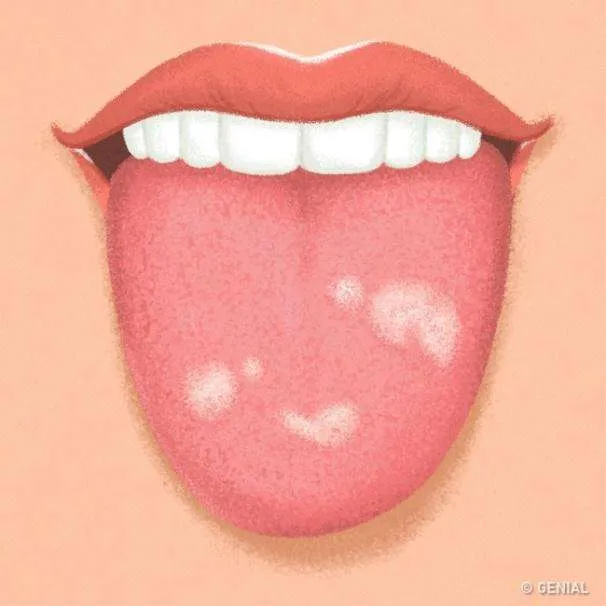 Candidiasis oral Candidiasis oral