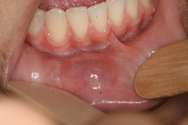 Tipos de mucocele Tipos de mucocele