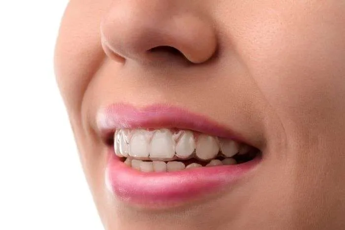 Invisalign ¿cuanto tiempo? Invisalign ¿cuanto tiempo?