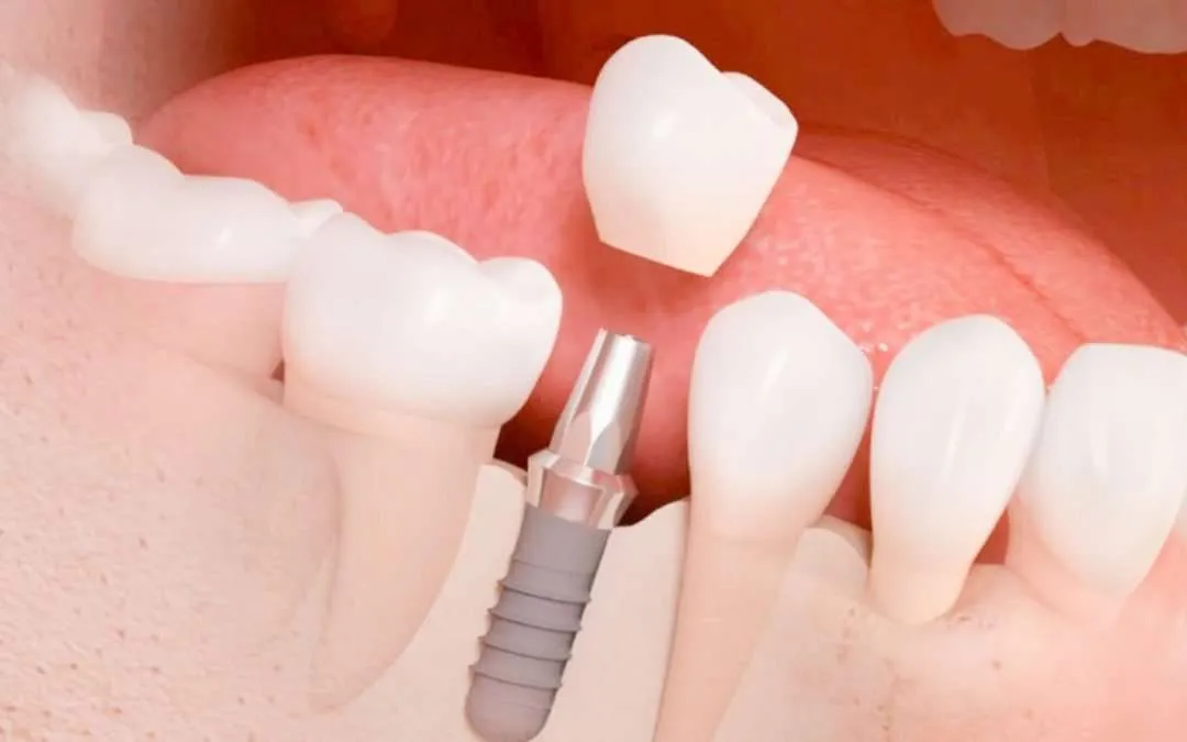 Proceso colocación implante dental Proceso colocación implante dental