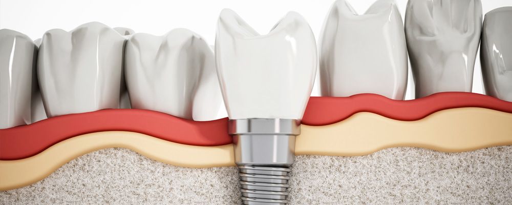 Funda de implante dental con el sistema CEREC