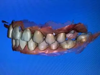 Paso 2 Sistema Cerec Paso 2 Sistema Cerec