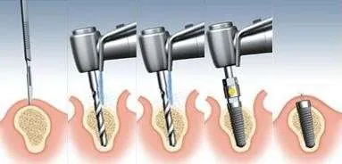 Proceso colocación implante dental Proceso colocación implante dental