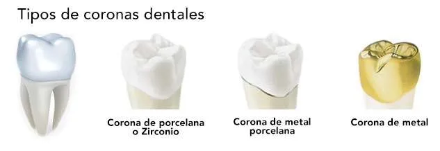 Tipos de coronas dentales Tipos de coronas dentales
