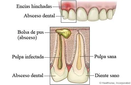 ¿Por que se realiza una apiceptomia? ¿Por que se realiza una apiceptomia?