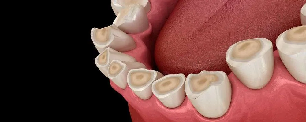 Causas erosión dental