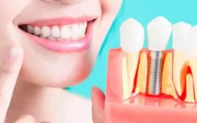 Guía definitiva para tener los mejores implantes dentales
