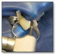 ¿Cómo se realiza el proceso de una incrustación dental? ¿Cómo se realiza el proceso de una incrustación dental?