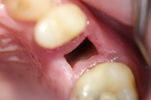 alveolitis seca alveolitis seca