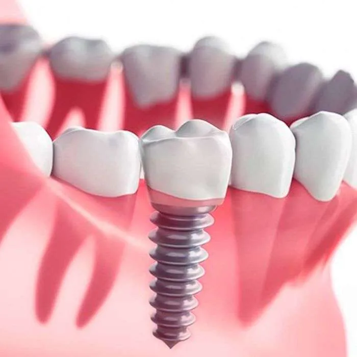 Alternativa implantes dentales Alternativa implantes dentales