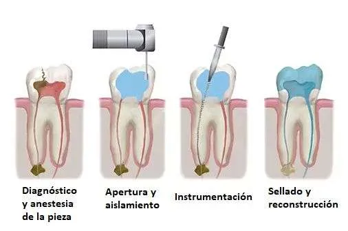 Proceso y evolución endodoncia Proceso y evolución endodoncia
