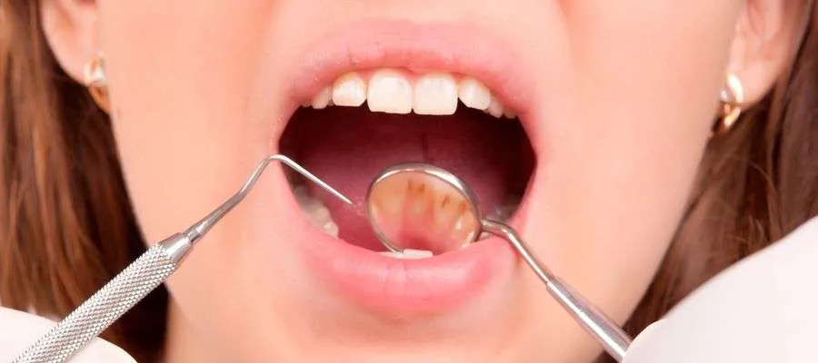 Caries dental Caries dental