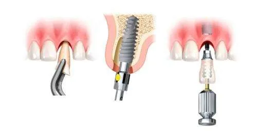 ¿Qué son los implantes dentales? ¿Qué son los implantes dentales?