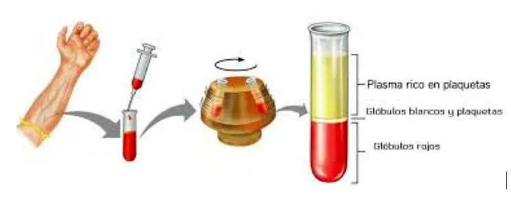 Proceso obtención plasma rico en plaquetas Proceso obtención plasma rico en plaquetas