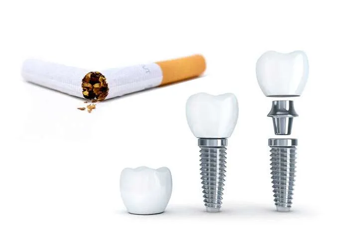 Hábitos y patologías rechazo implantes dentales Hábitos y patologías rechazo implantes dentales