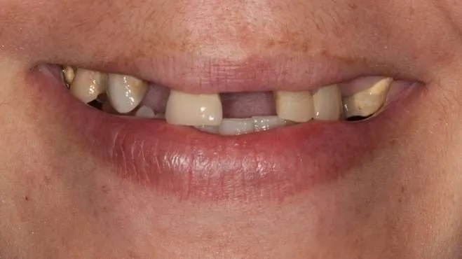 Caso real implante carga inmediata Clínica Dentisalut Caso real implante carga inmediata Clínica Dentisalut